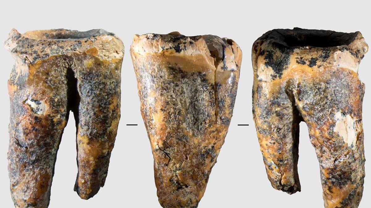 Neanderthals treated a dental cavity by drilling into the tooth