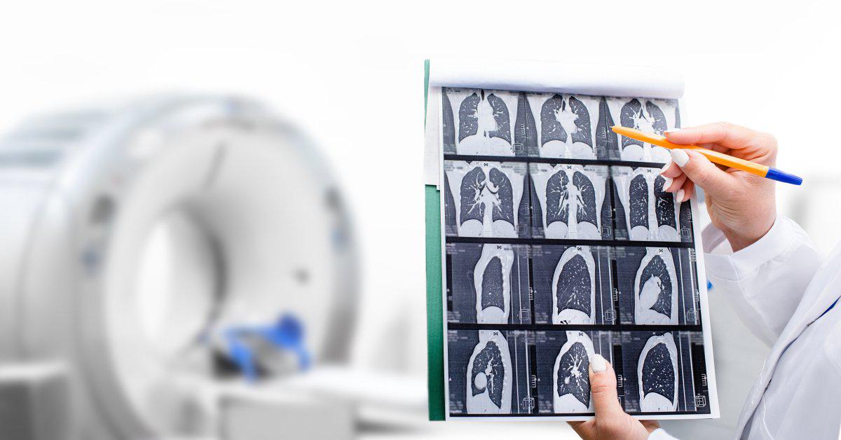 Experts Want More People Screened for Lung Cancer. Here's Why