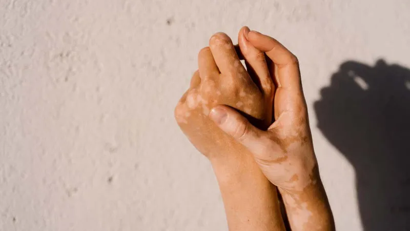 Landmark vitiligo cream targets immune cells that disrupt pigmentation