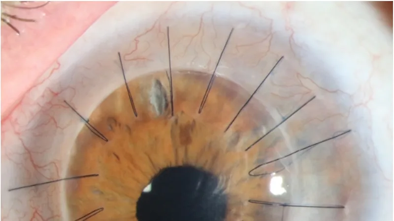 They were blinded in accidents. Now, they can see again.
