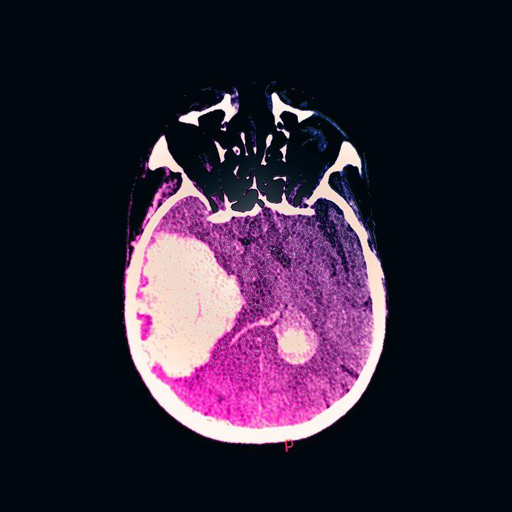 Heavy drinking linked to deadlier brain hemorrhages