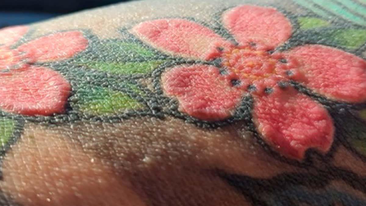Red tattoo ink causes man to lose all his hair and stop sweating