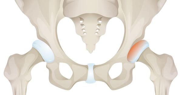What the Acetabulum Can Teach Us About Marriage