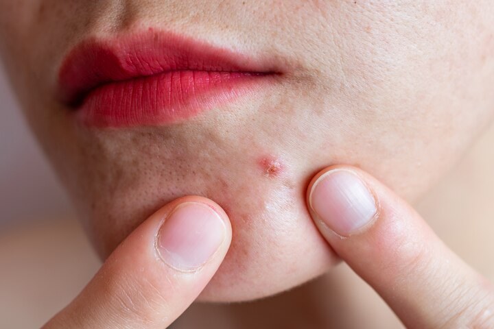 How eczema and acne can affect your mental health