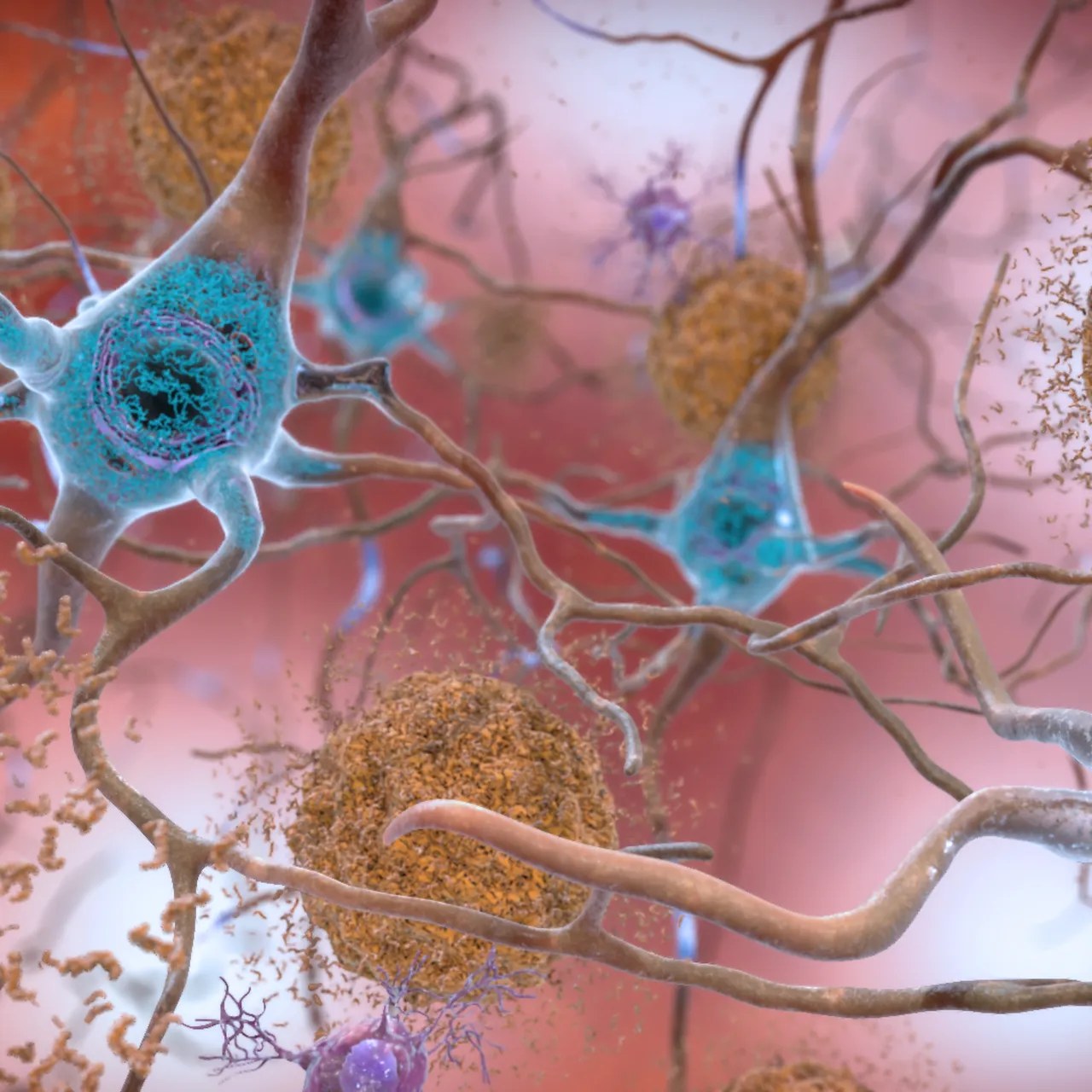 Experimental Alzheimer’s Drug That Fights a Tough-to-Target Protein Shows Promise at Slowing Cognitive Decline in a Clinical Trial